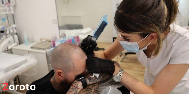 Scalp Micropigmentation Liverpool